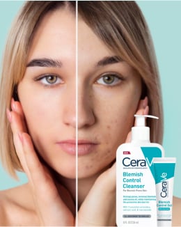 Cremes para Acne